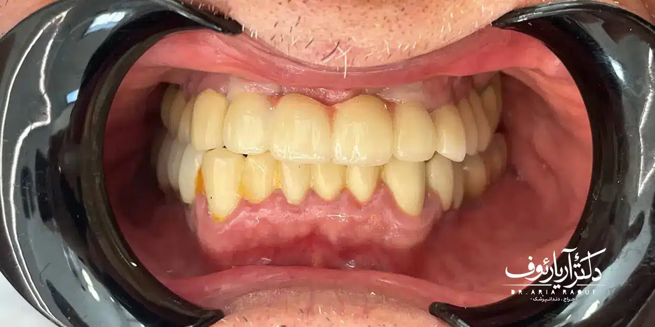 درمان موفق با ایمپلنت در تبریز (شرایط اقساطی) | کلینیک دکتر رئوف نتیجه نهایی جایگزینی بریج با دو واحد ایمپلنت دندان در تبریز توسط دکتر رئوف