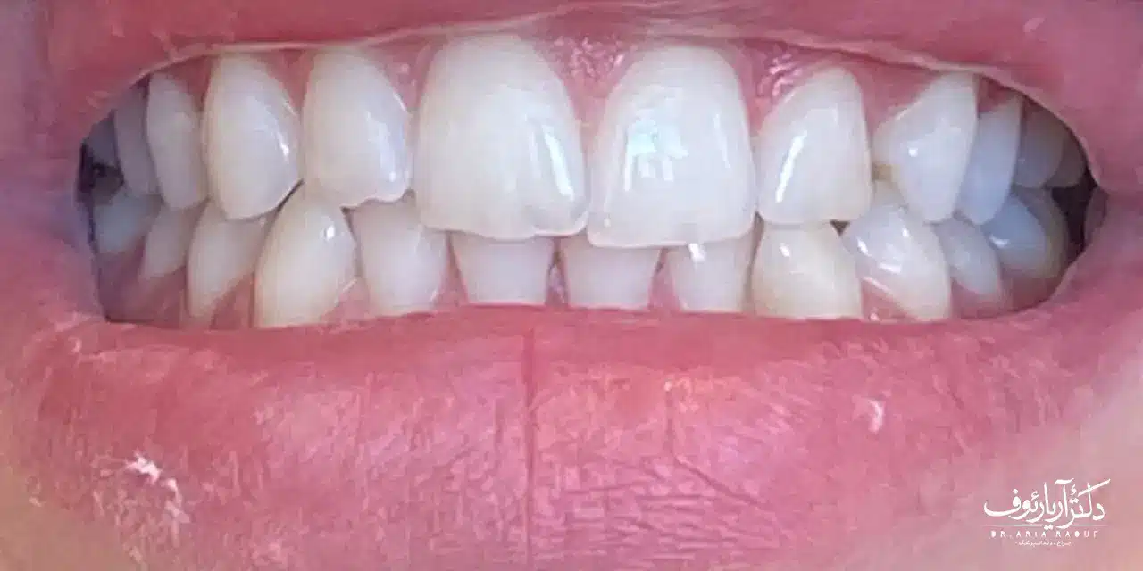 نتیجه نهایی سفید کردن دندان با دستگاه در تبریز | کلینیک دکتر رئوف نتیجه درخشان و لبخند سفید بیمار پس از بلیچینگ دندان در تبریز توسط دکتر رئوف