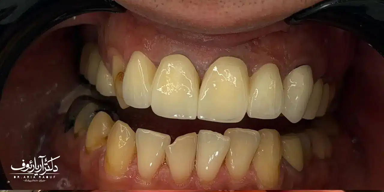 نتیجه نهایی و زیبای بریج دندان تمام سرامیک پس از درمان توسط متخصص پروتز دندان در تبریز