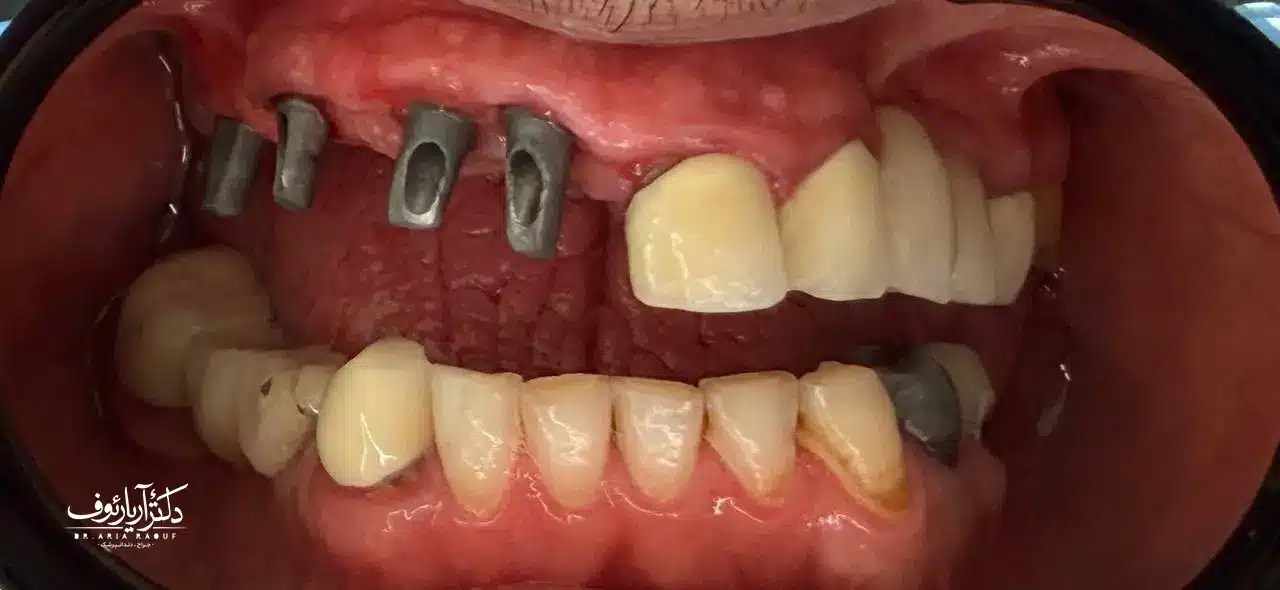 نیاز به پیوند استخوان قبل از درمان ایمپلنت در تبریز عکس رادیوگرافی بیمار نشاندهنده تحلیل استخوان فک قبل از کاشت ایمپلنت در تبریز