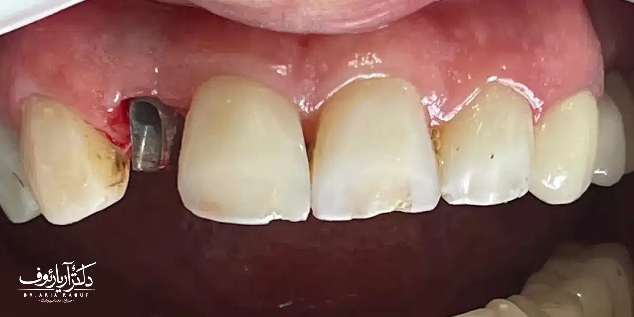 طراحی سه بعدی ایمپلنت دیجیتال در تبریز | کلینیک دکتر رئوف برنامهریزی و طراحی ایمپلنت دیجیتال (کامپیوتری) قبل از کاشت دندان در تبریز