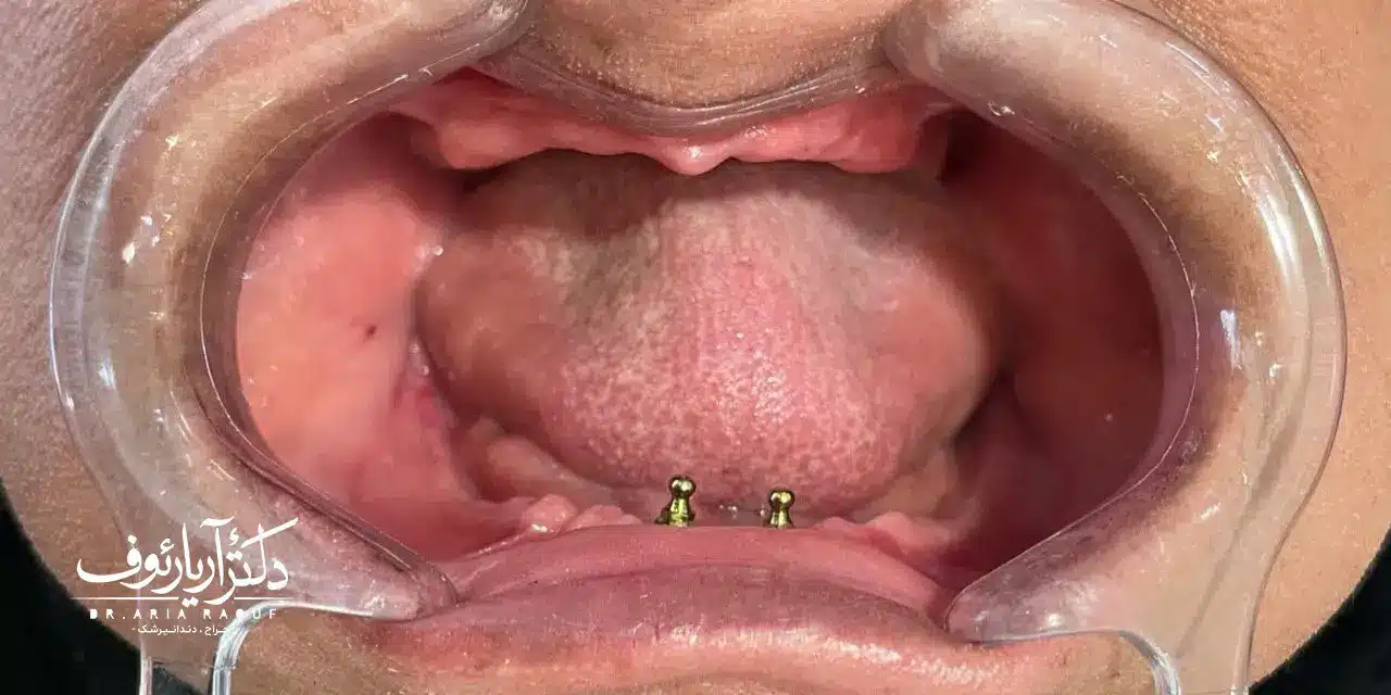 تصویر بیمار با دست دندان (دندان مصنوعی) قدیمی و نامناسب قبل از درمان در تبریز