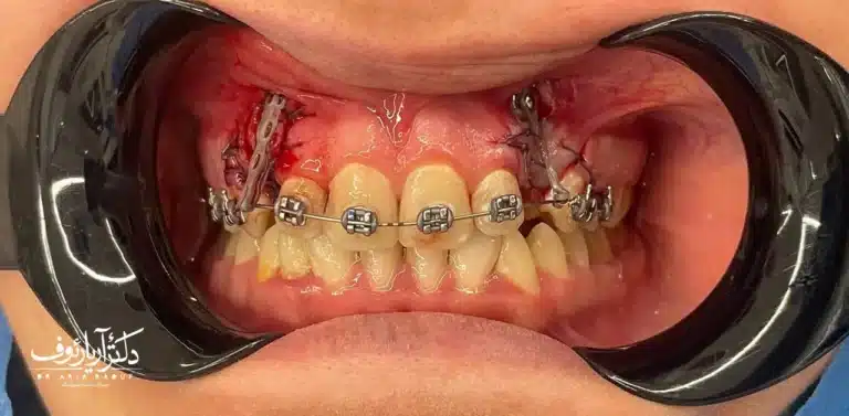 عکس رادیوگرافی بیمار نشان‌دهنده دندان نیش نهفته قبل از جراحی و ارتودنسی تخصصی در تبریز