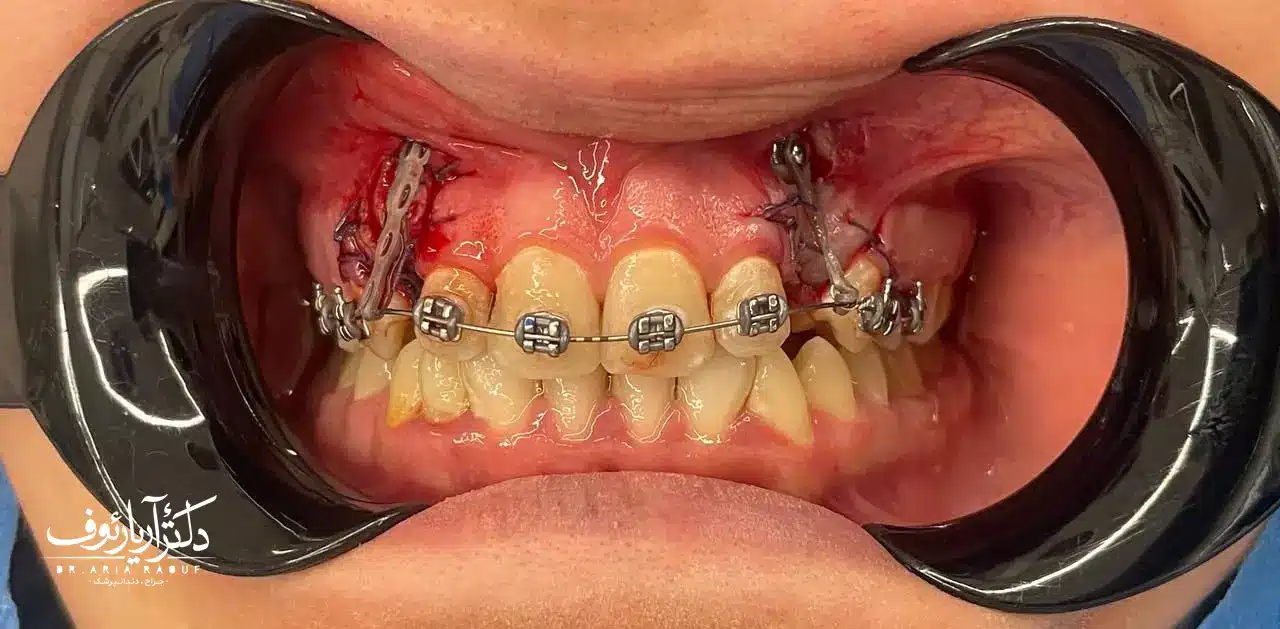 عکس رادیوگرافی بیمار نشان‌دهنده دندان نیش نهفته قبل از جراحی و ارتودنسی تخصصی در تبریز