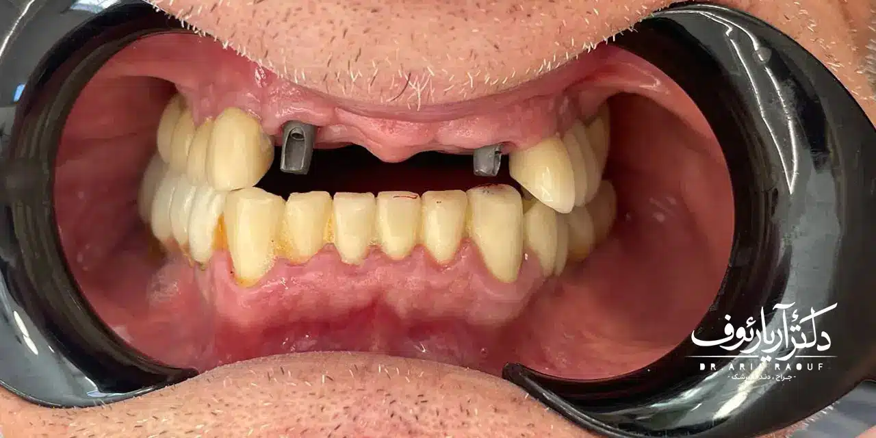 وضعیت بریج قدیمی و پوسیدگی دندان پایه قبل از کاشت ایمپلنت تصویر بریج (پل دندانی) قدیمی و ناموفق بیمار قبل از درمان ایمپلنت دندان در تبریز