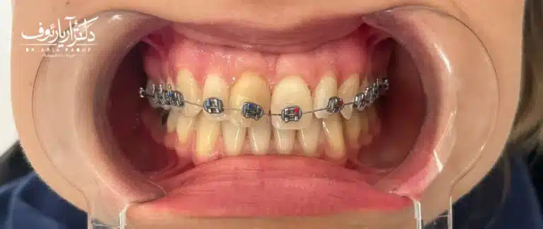 تصویر دندان‌های نامرتب و شلوغ بیمار قبل از شروع درمان ارتودنسی نامرئی در تبریز