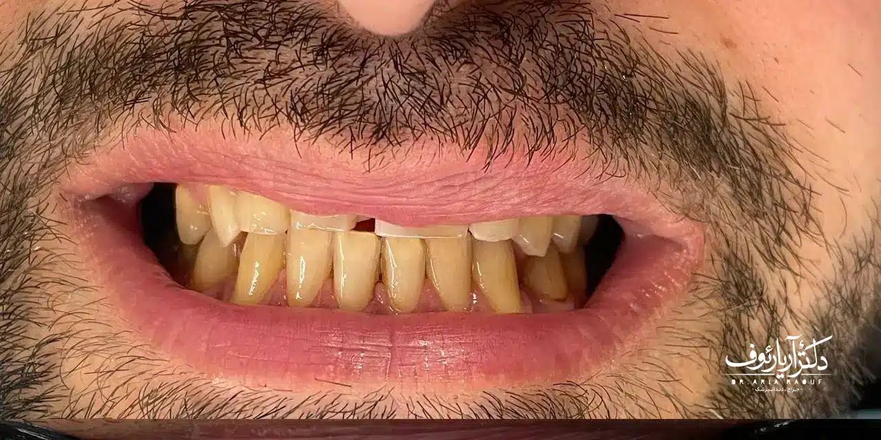 تصویر کامپوزیت‌های قدیمی، زرد و لب‌پر شده بیمار قبل از درمان لمینت دندان در تبریز