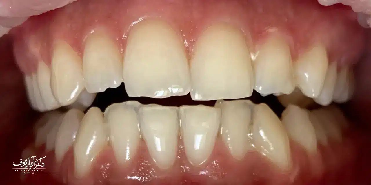 وضعیت دندانها قبل از سفید کردن دندان در مطب در تبریز تصویر دندانهای زرد و کدر بیمار قبل از شروع درمان بلیچینگ دندان در تبریز