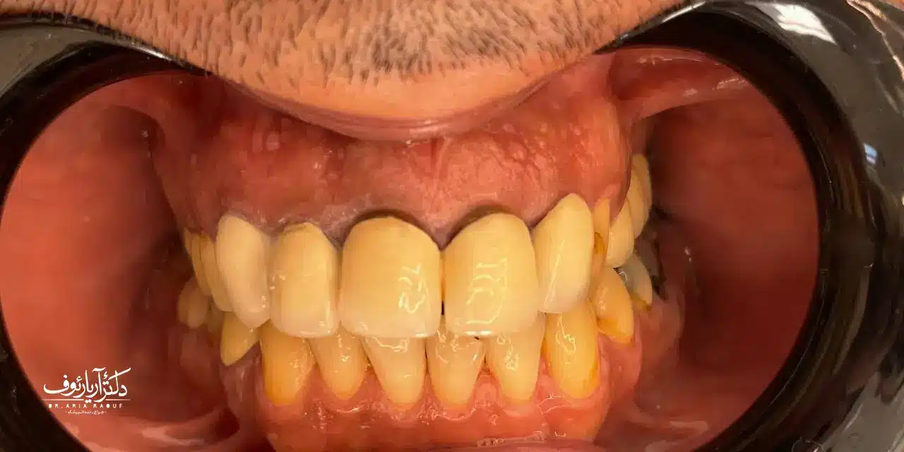 تصویر بریج دندان قدیمی فلزی-سرامیکی (PFM) بیمار قبل از تعویض با روکش زیرکونیا در تبریز