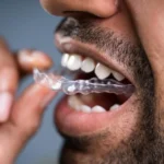 روشهای درمان دندان قروچه (براکسیسم) در تبریز با استفاده از نایت گارد تخصصی