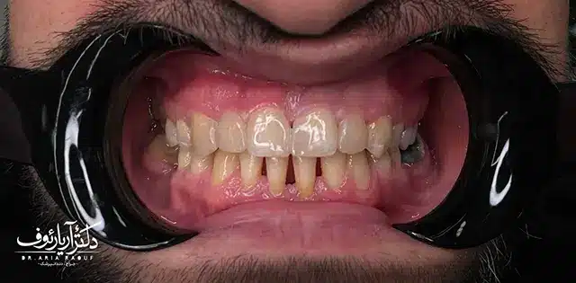 تصویر قبل و بعد از بستن فاصله بین دندان با کامپوزیت دندان جلو در تبریز