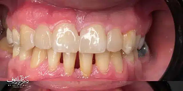 تصویر بیمار که نشان‌دهنده بعد از درمان کامپوزیت دندان در یک جلسه در تبریز است