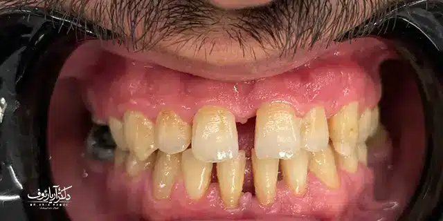 تصویر بیمار که نشان‌دهنده قبل از درمان کامپوزیت دندان در یک جلسه در تبریز است