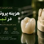 راهنمای کامل هزینه انواع پروتز دندان در تبریز شامل قیمت روکش، دندان مصنوعی و بریج