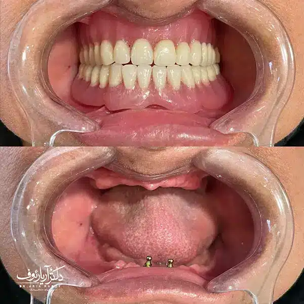 نمونه پروتز دندان (دندان مصنوعی و روکش زیرکونیا) در تبریز | کلینیک دکتر رئوف