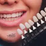 اینفوگرافیک مقایسه کامل تفاوتهای لمینت سرامیکی و ونیر کامپوزیت دندان