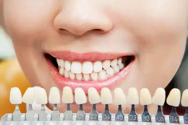 جدول مقایسه کامل تفاوت‌های لمینت سرامیکی و ونیر کامپوزیت از نظر مزایا و معایب