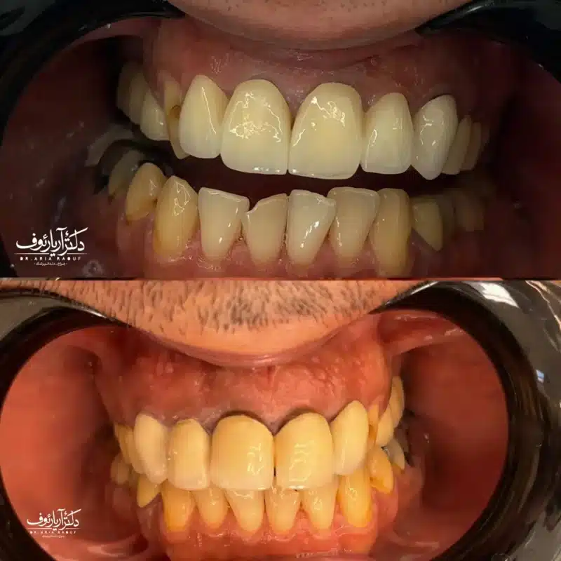 نمونه روکش زیرکونیا و بریج دندان (پل دندانی) در تبریز