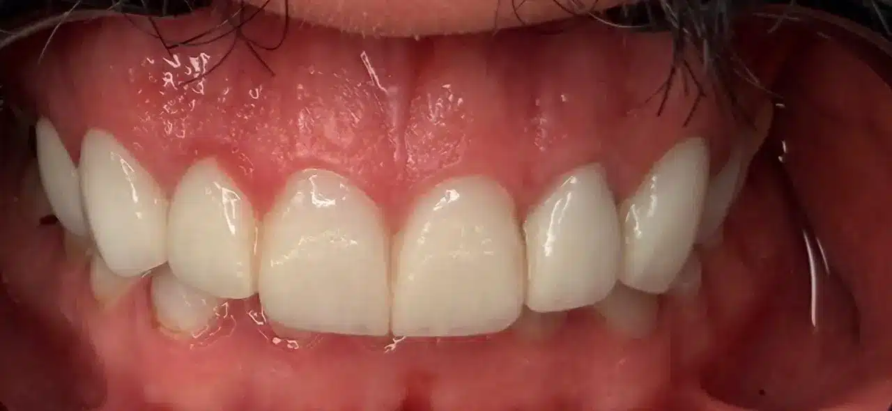 لبخند شفاف و طبیعی با لمینت سرامیکی نتیجه نهایی تعویض کامپوزیت با لمینت سرامیکی شفاف توسط دکتر رئوف در تبریز