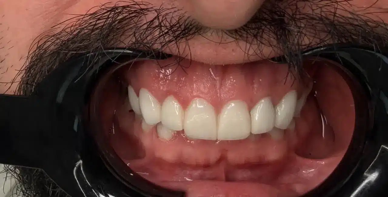 دندانهای مرتب شده با لمینت در تبریز نتیجه نهایی صاف کردن دندانهای کج با لمینت سرامیکی توسط دکتر رئوف در تبریز