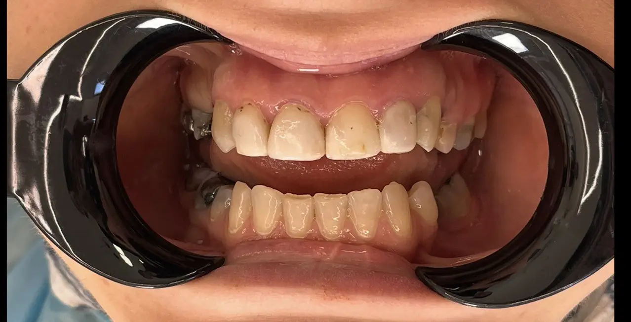 دندانهای قبل از اصلاح طرح لبخند در کلینیک دکتر رئوف تصویر دندانهای زرد و لکهدار تتراسایکلینی قبل از انجام لمینت سرامیکی در تبریز