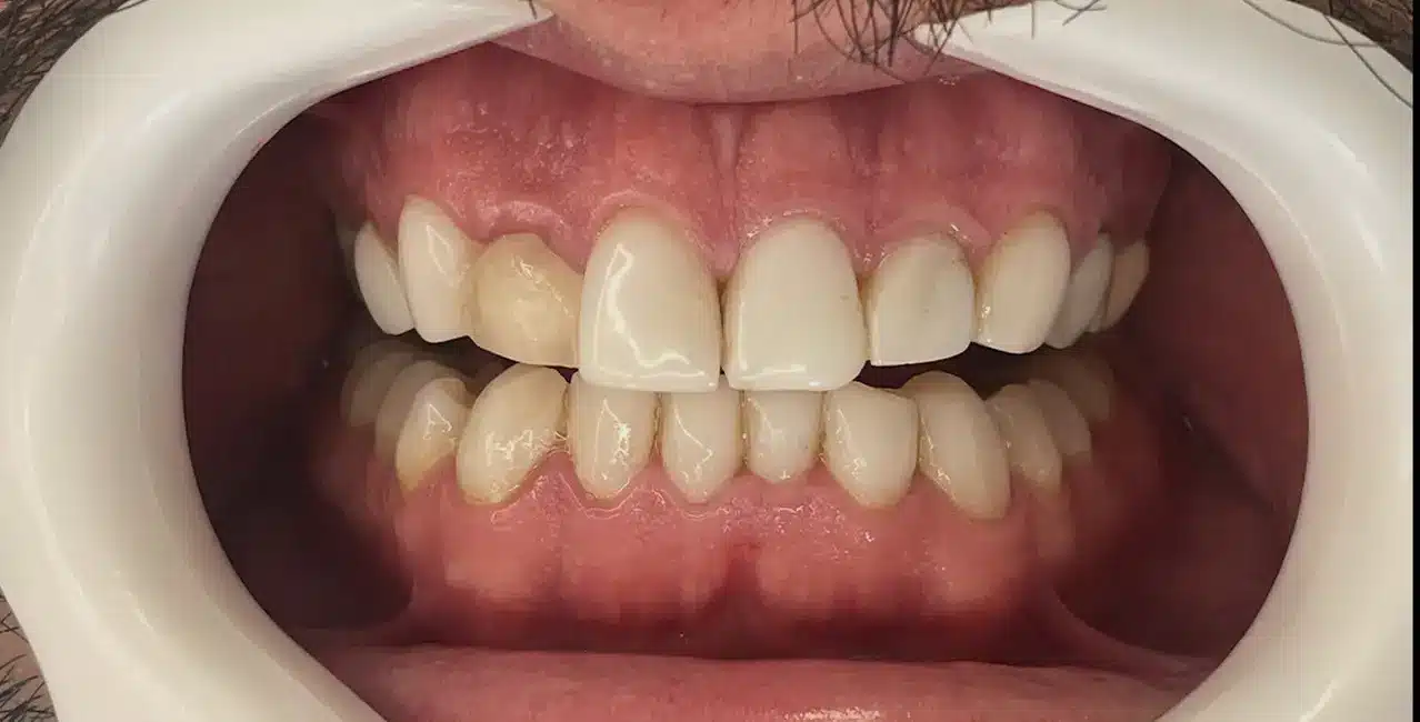 دندانهای نامرتب قبل از درمان زیبایی تصویر دندانهای کج و نامرتب قبل از اصلاح با لمینت در تبریز (جایگزین ارتودنسی)