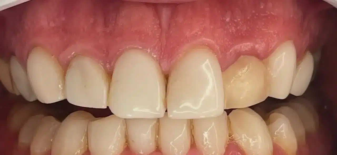 کامپوزیتهای قدیمی و نامناسب (قبل از درمان) تصویر کامپوزیتهای قدیمی تغییر رنگ یافته و مات قبل از تعویض با لمینت در تبریز