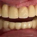 مقایسه ایمپلنت دیجیتال در تبریز و ایمپلنت معمولی در تبریز بدون بخیه