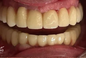 مقایسه ایمپلنت دیجیتال در تبریز و ایمپلنت معمولی در تبریز بدون بخیه