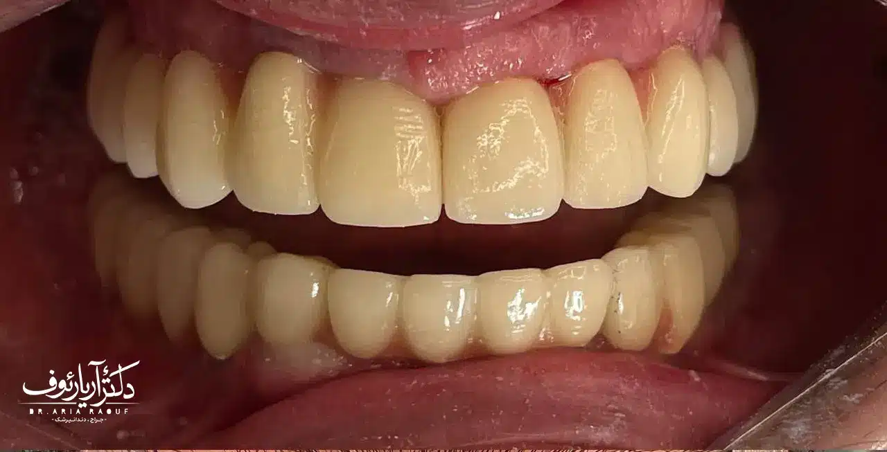 مقایسه ایمپلنت دیجیتال در تبریز و ایمپلنت معمولی در تبریز بدون بخیه