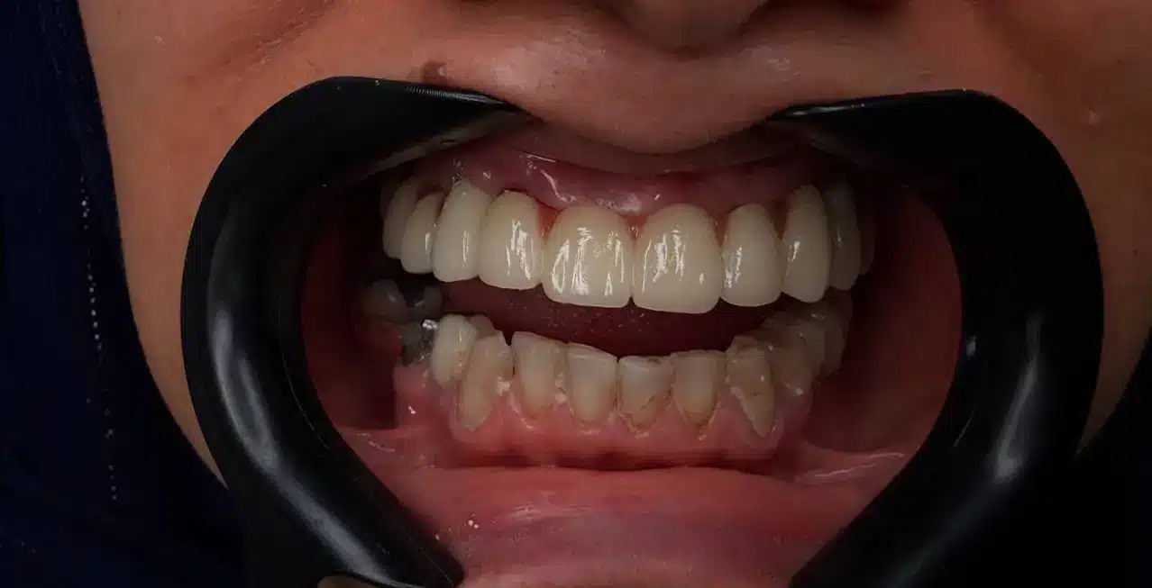 ایمپلنت دندان جلو در تبریز با روکش موقت مقایسه قبل و بعد ایمپلنت فوری دندان جلو در تبریز (کاشت دندان یک روزه)