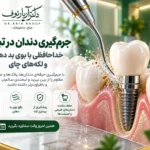 انجام جرم گیری دندان و بروساژ تخصصی در کلینیک دکتر رئوف تبریز