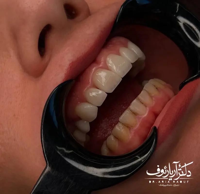 اصلاح طرح لبخند با کامپوزیت رنگ سوپر بلیچ در تبریز