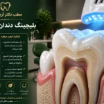 بررسی میکروسکوپی تاثیر ژل سفیدکننده بر مینای دندان جهت تحلیل عوارض بلیچینگ دندان در کلینیک تخصصی
