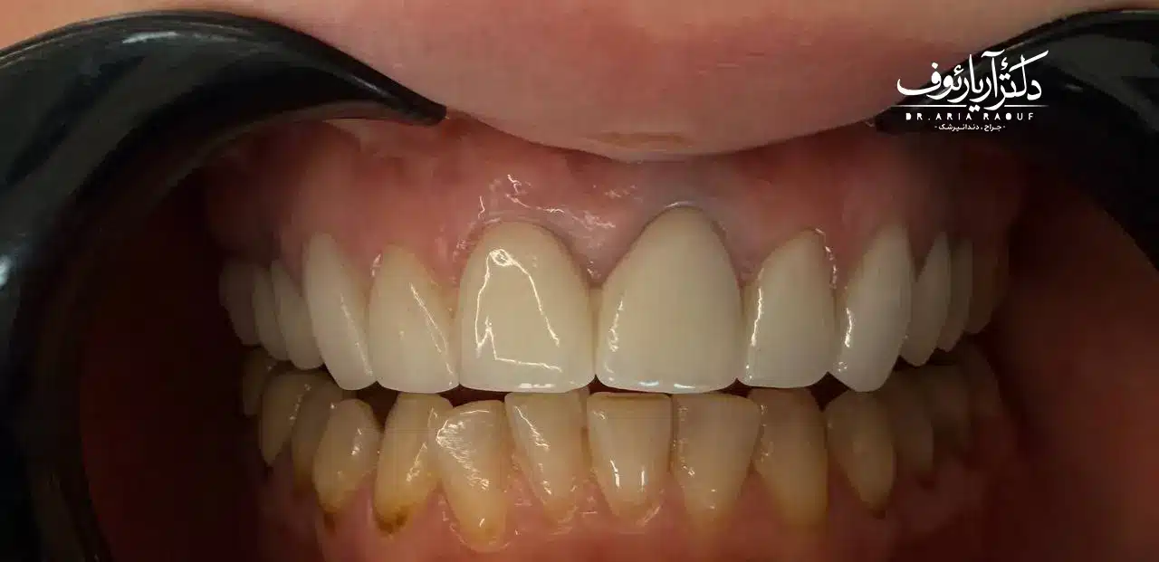 لمینت سرامیکی طبیعی دندان جلو نتیجه نهایی تعویض روکش قدیمی با لمینت سرامیکی ظریف و نچرال در تبریز کلینیک دکتر رئوف