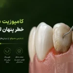 بررسی کامل عوارض کامپوزیت دندان و علت بوی بد دهان و پوسیدگی دندان زیرین ۱۴۰۵