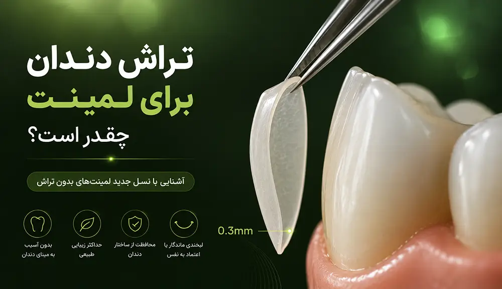 راهنمای جامع میزان تراش دندان برای لمینت و معرفی نسل جدید لمینتهای بدون تراش در تبریز سال ۱۴۰۵