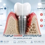 بررسی علت شکست ایمپلنت دندان و تحلیل استخوان فک