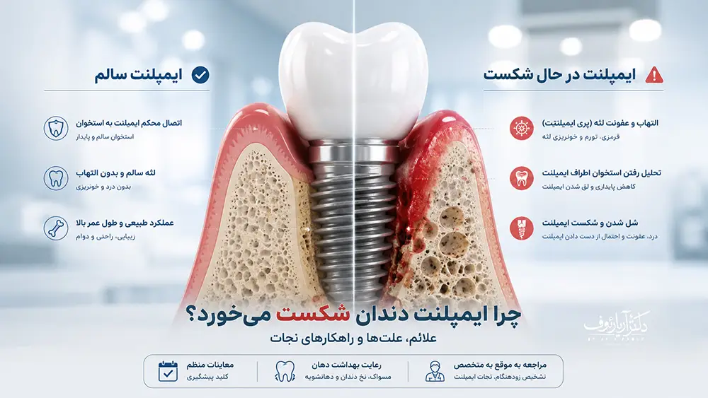 بررسی علت شکست ایمپلنت دندان و تحلیل استخوان فک