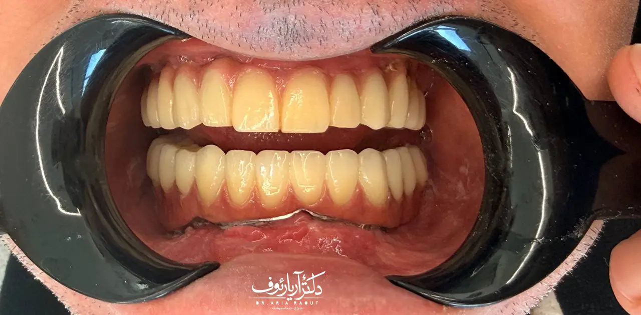 نتیجه بازسازی کامل دهان با فول ایمپلنت فک بالا و پایین در تبریز