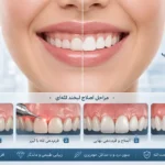 اصلاح لبخند لثه ای و جراحی لیفت لثه در تبریز
