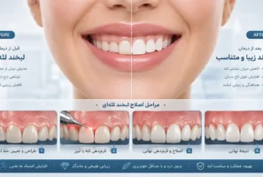 اصلاح لبخند لثه ای و جراحی لیفت لثه در تبریز