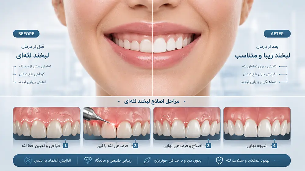 اصلاح لبخند لثه ای و جراحی لیفت لثه در تبریز