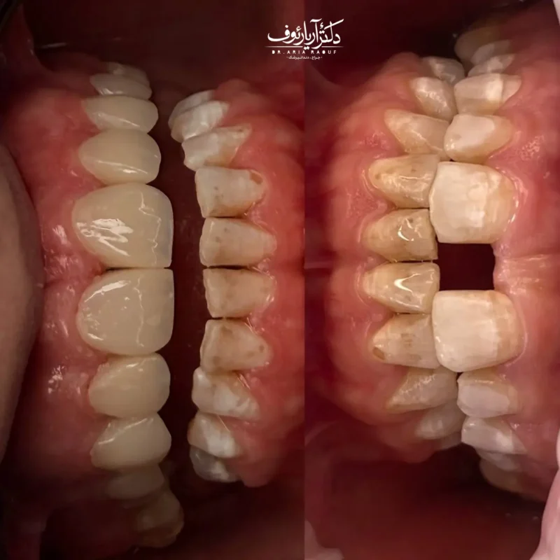 تصویر قبل از لمینت سرامیکی و وجود فاصله دندانی فک بالا در تبریز