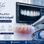مراحل و طول دوره انجام لمینت دندان در تبریز از اسکن دیجیتال تا نصب