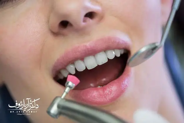 تری اختصاصی قالب‌گیری شده هوم بلیچینگ خانگی در تبریز