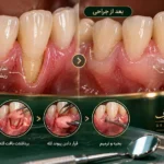جراحی پیوند بافت لثه برای درمان تحلیل و پوشاندن ریشه دندان در کلینیک دندانپزشکی تبریز