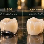 مقایسه روکش دندان تمام سرامیک زیرکونیا با روکش فلزی سرامیکی PFM در کلینیک دکتر آریا رئوف
