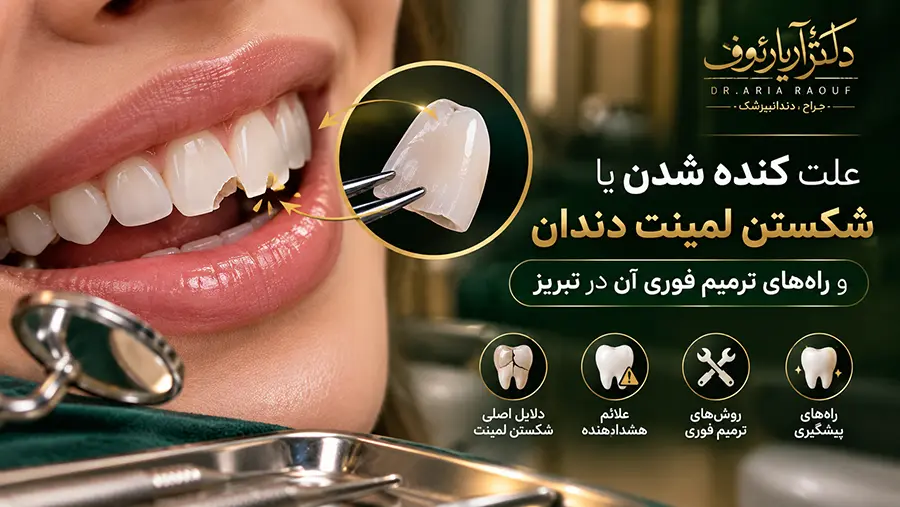 پوسته لمینت سرامیکی دندان جلو جدا شده و آماده ترمیم و چسباندن مجدد در مطب دندانپزشکی در تبریز