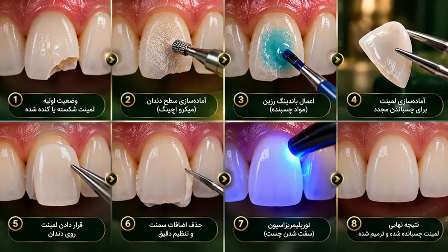 مراحل آمادهسازی و چسباندن مجدد لمینت دندان آسیبدیده با سمان رزینی در کلینیک دندانپزشکی در تبریز